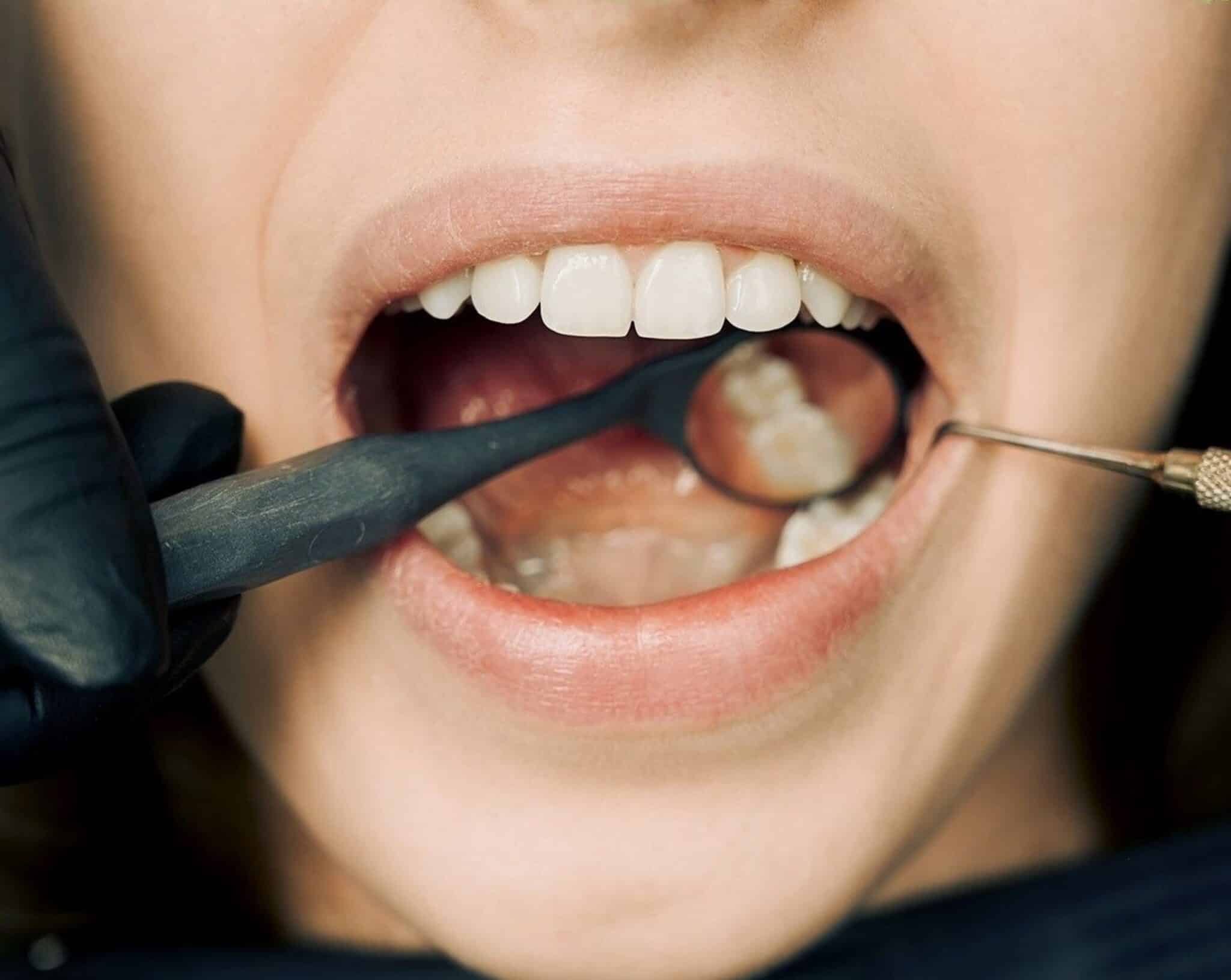Scaling & Root Planing vs. Dental Cleaning Baton Rouge Dentist